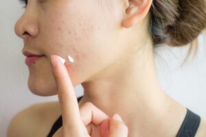 Skin Purging VS Breakout, Apa Bedanya?