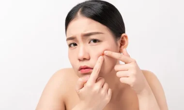 4 tips jitu memencet jerawat